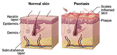 psoriasis-